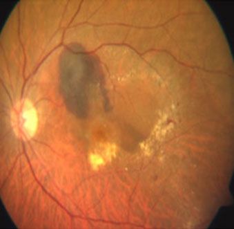 Macular Degeneration