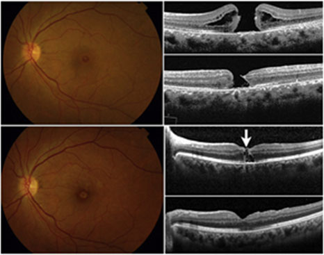 Macular Hole