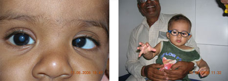 Pediatric Cataract