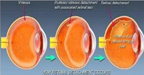 Posterior vitreous