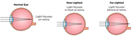 Refractive Errors