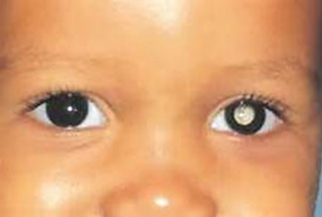 Retinoblastoma