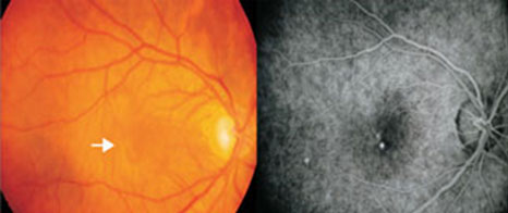 Central serous chorioretinopathy